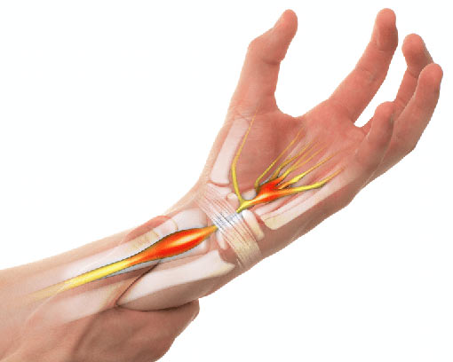 Carpal Tunnel Syndrome